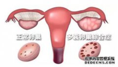 多囊卵巢综合症会引起不孕吗