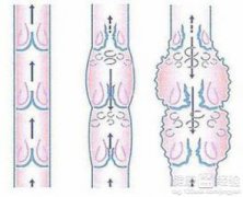 <b>什么是静脉炎</b>