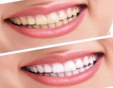 四环素牙应该怎么治疗?