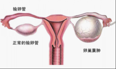 卵巢囊肿的原因有哪些